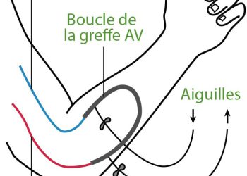 découvrez les symptômes, les risques et les principaux traitements de la phlébite pour mieux comprendre cette maladie veineuse et agir rapidement.