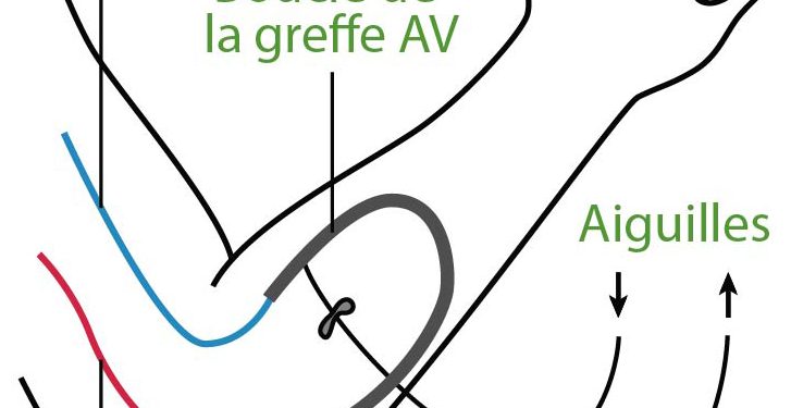 découvrez les symptômes, les risques et les principaux traitements de la phlébite pour mieux comprendre cette maladie veineuse et agir rapidement.